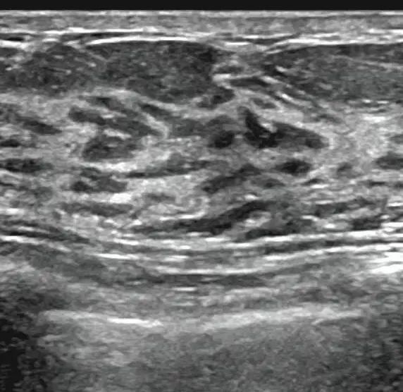 乳腺結(jié)節(jié)惡性的可能性有多大?一文讀懂乳腺結(jié)節(jié)BI-RADS分級(jí)標(biāo)準(zhǔn)!