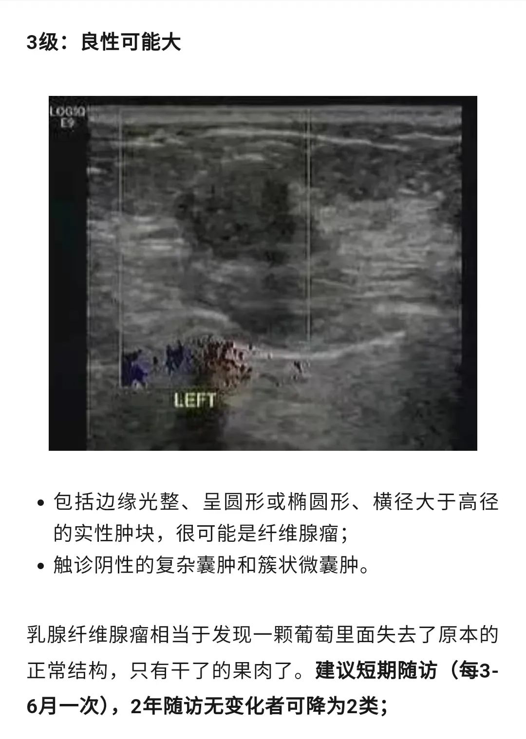 乳腺結(jié)節(jié)惡性的可能性有多大?一文讀懂乳腺結(jié)節(jié)BI-RADS分級(jí)標(biāo)準(zhǔn)!